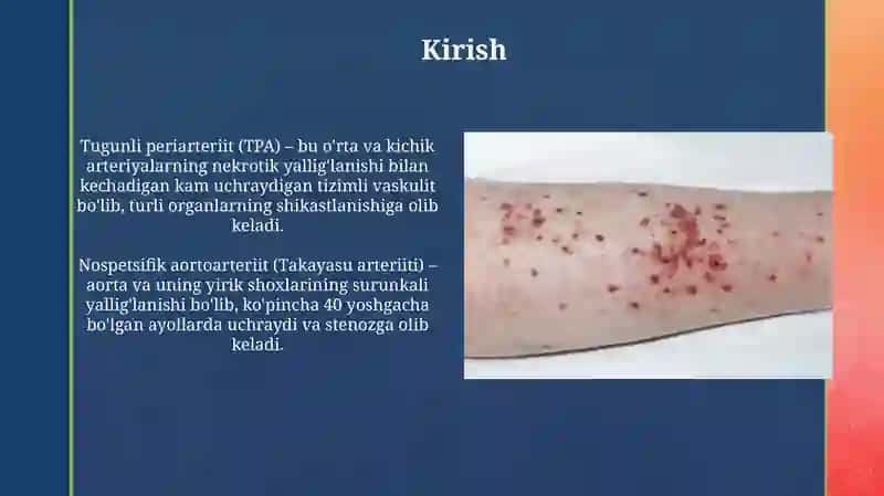 Tugunchali periartrit, nospetsifik aortaartrit kasalliklari diagnostikasi 3