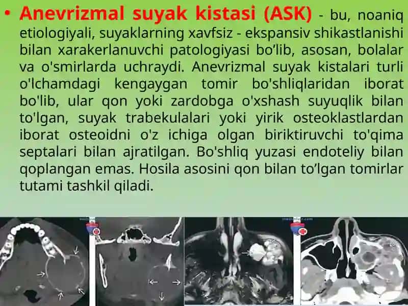 Anevrizmal suyak kistasi (ASK) 3