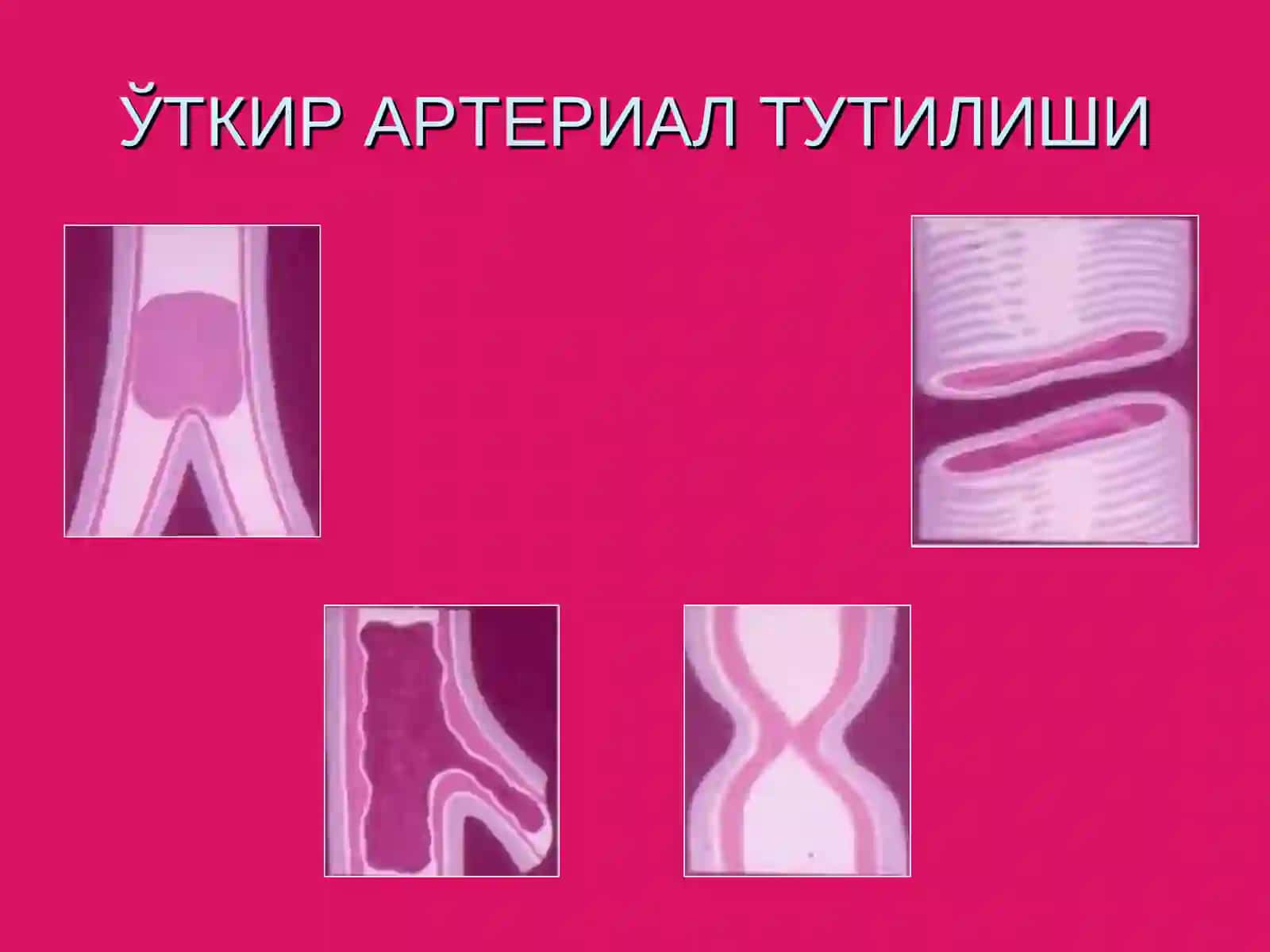 Ўткир артериал тромбози ва эмболиялари 3