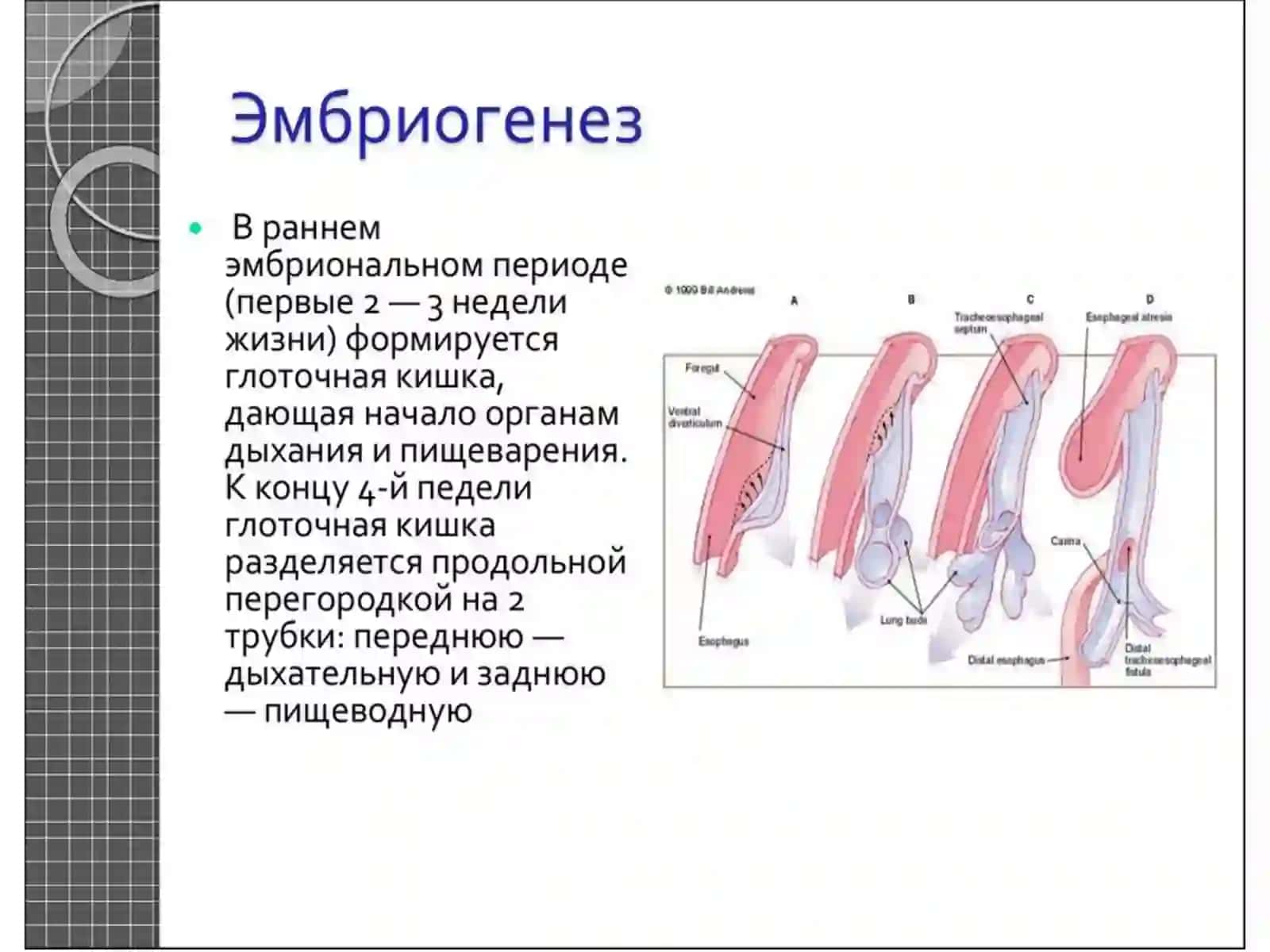Атрезия Пищевода 3
