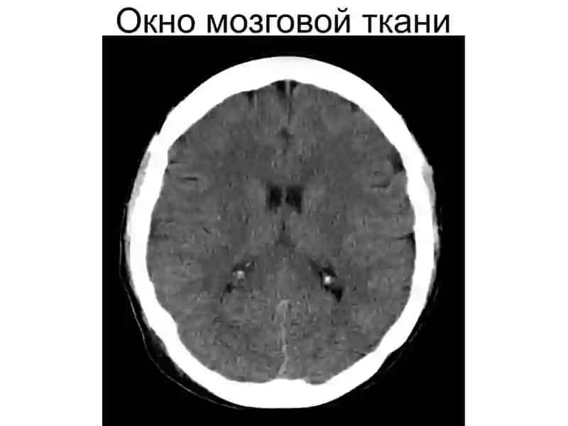 КТ, МРТ головного мозга 3