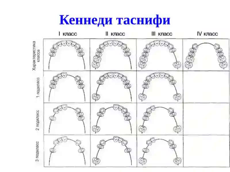 Таянч тишлар билан даволаш 3