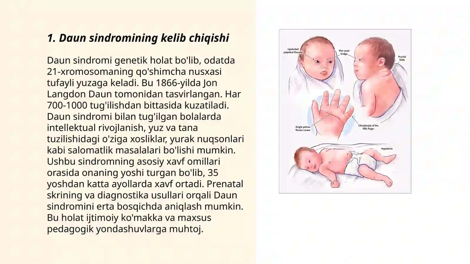 Daun sindromi 3