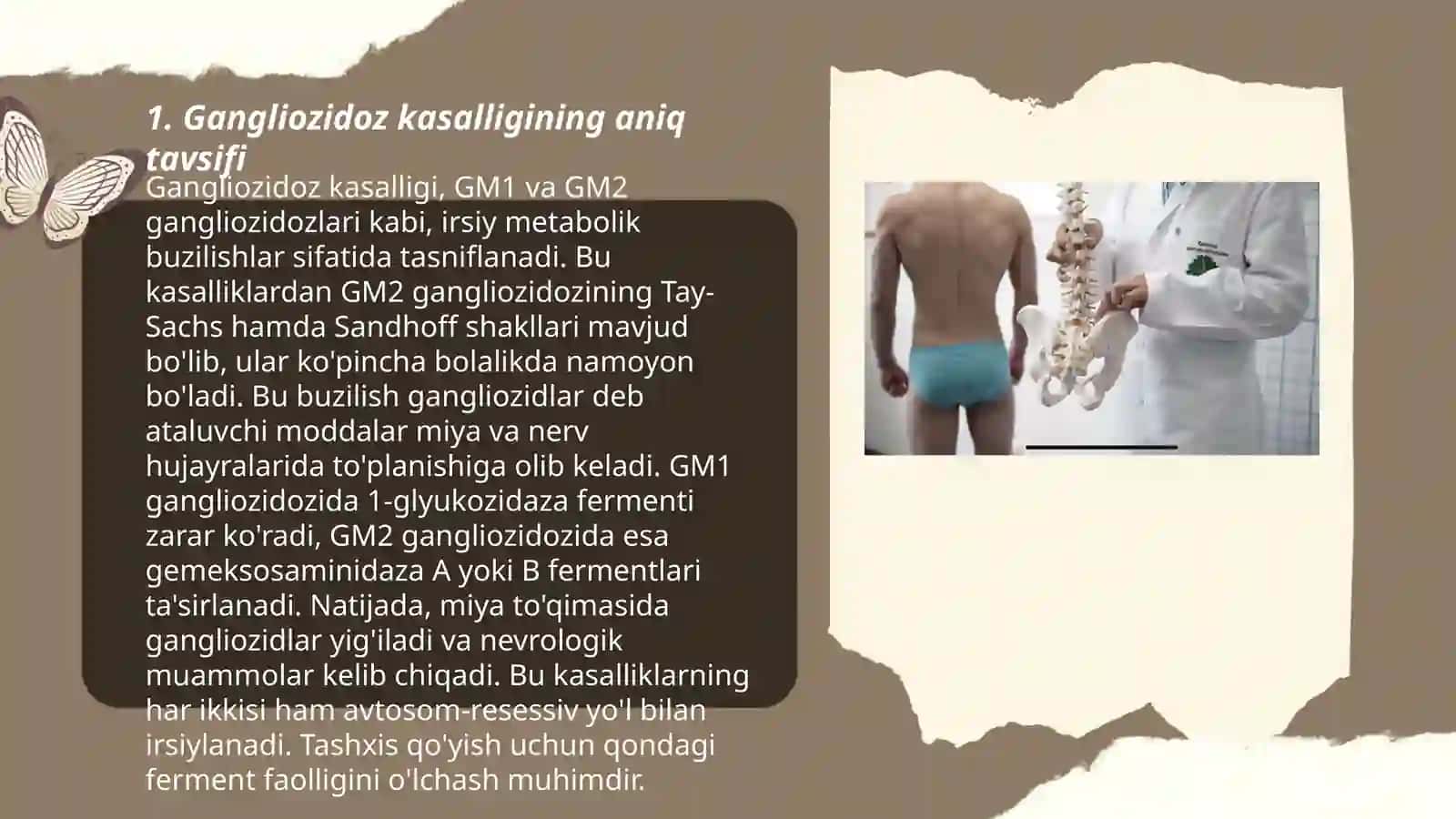 Gangliozidoz kasalligi 3