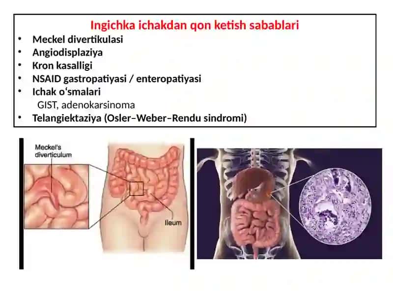 Ichakdan qon ketishi 3