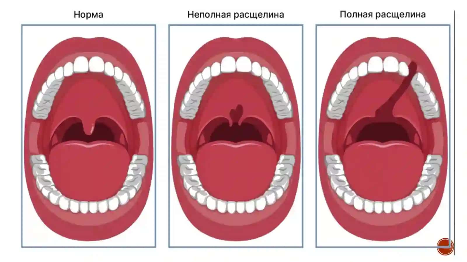 Туғма танглай кемтиги 3