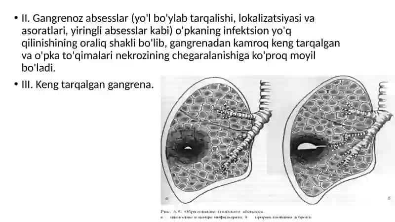 O’pka absessi patogenezi klinikasi va diagnostikasi 3