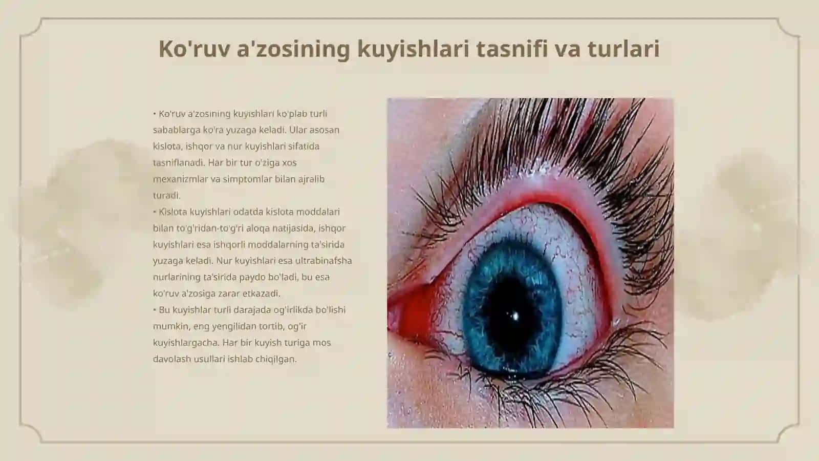 Ko'ruv a'zosining kuyishlari tasnifi 3