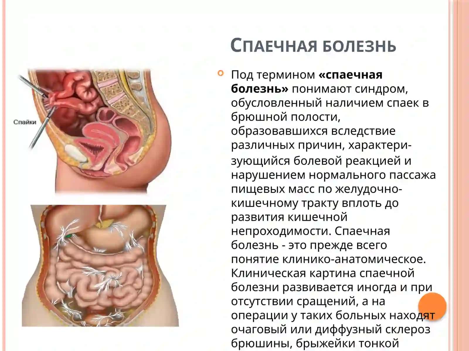 Спаечная болезнь: Этиология, виды, лечение 3