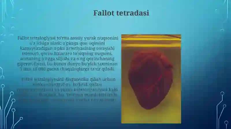 Fallot tetralogiyasi 3