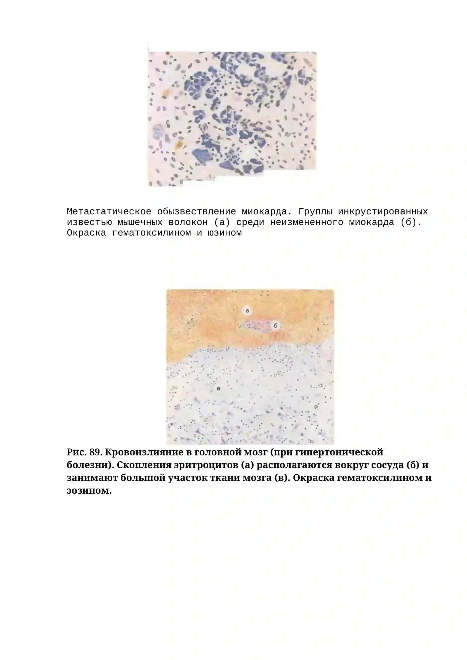 Атеросклероз аорты 3