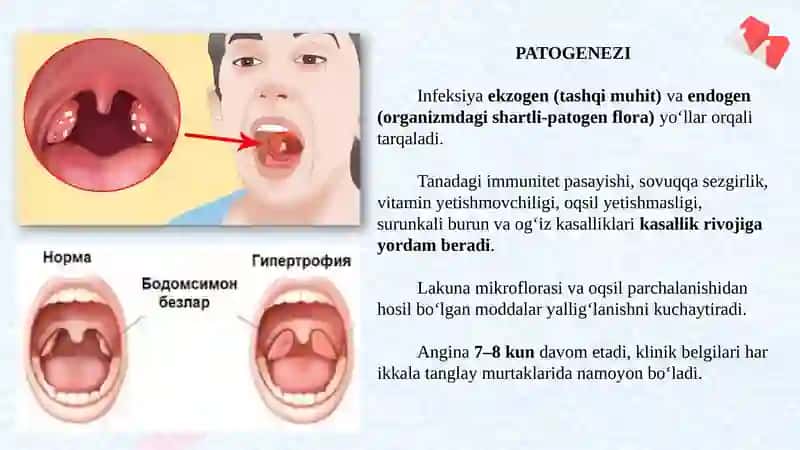QON KASALLIKLARIDA IKKILAMCHI ANGINALAR 3