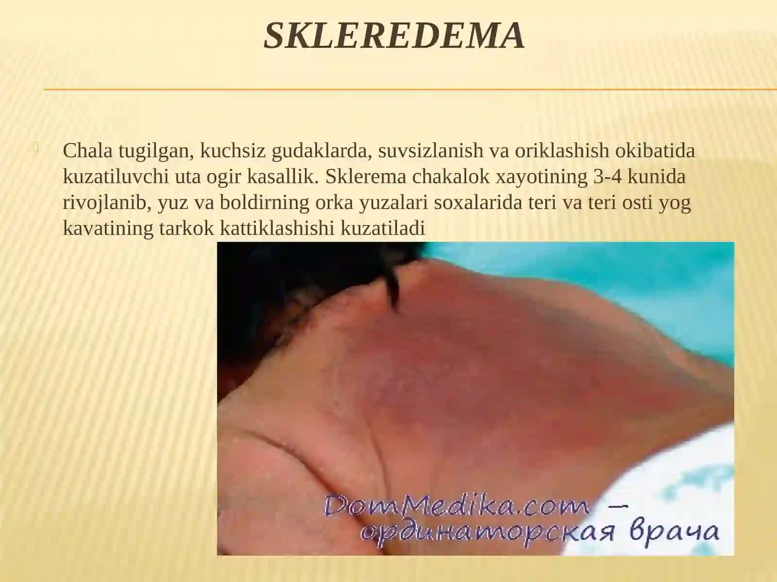 Yangi tug’ilgan chaqaloqlarning teri kasalliklari 3