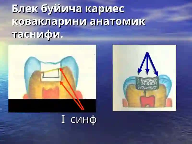 Кариес ковакни чархлаш босқичлари ва услублари 3