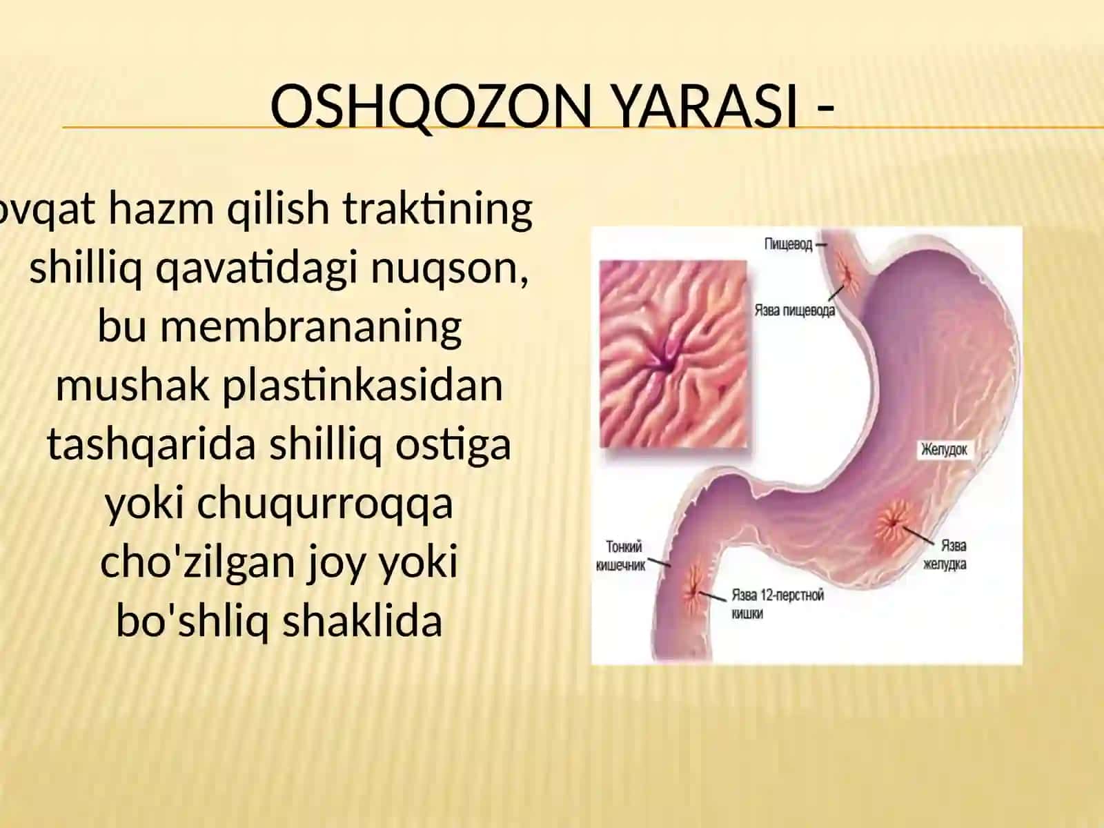 Oshqozon yarasi 3