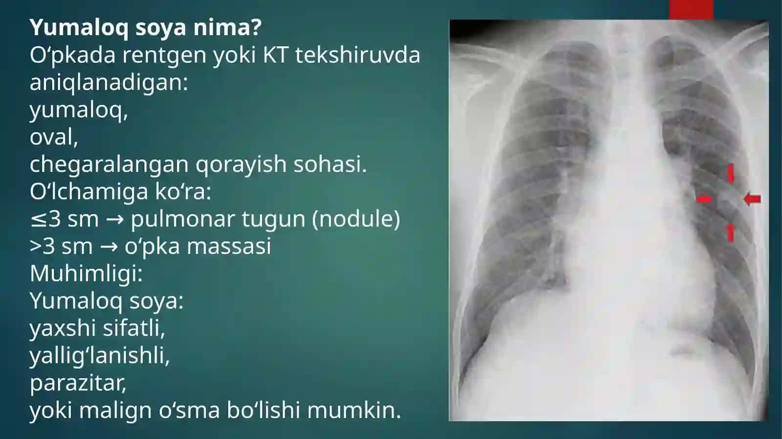Oʻpka ichidagi yumaloq soyani tashxislash 3