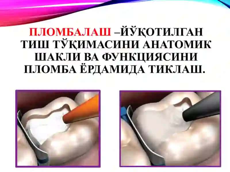 Пломба ашёларининг таснифи 3