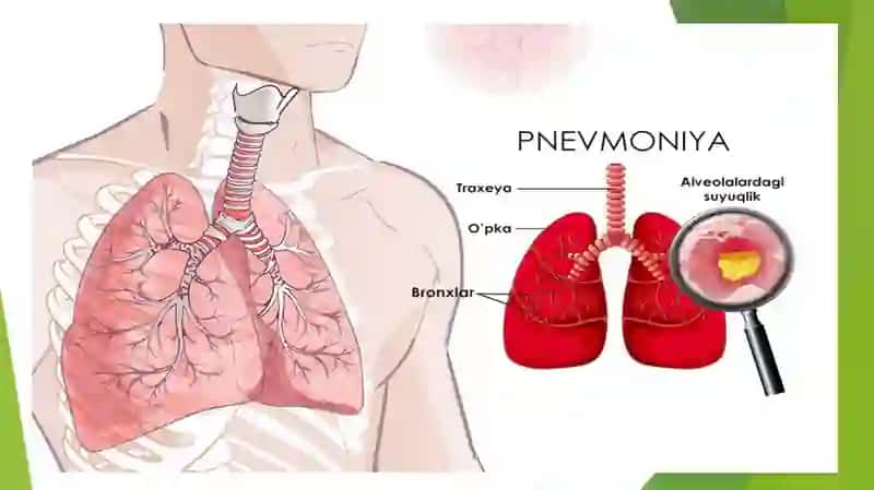 PNEVMONIYA tasnifi, klinikasi, tashxisi va davolash 3