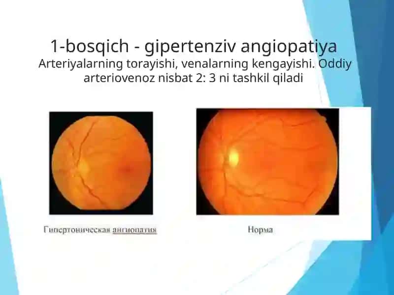 Umumiy kasalliklarida ko'rish organidagi o'zgarishlar 3