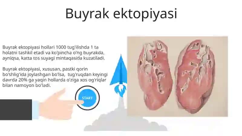 Buyrak ektopiyasi 3