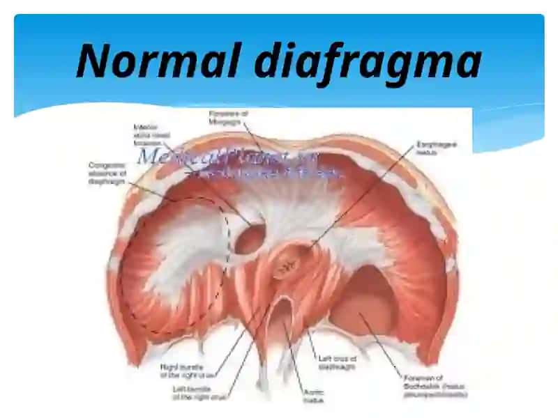 Diafragmal churralar. Etiologiya, patogenez, klinika, diagnostika 3