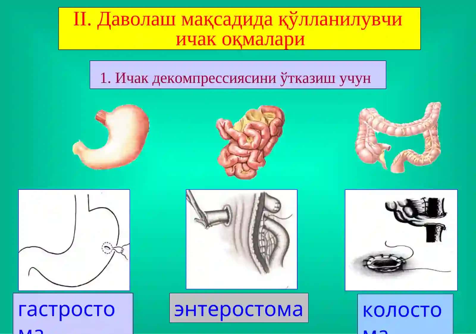 Ичак оқмалари 3