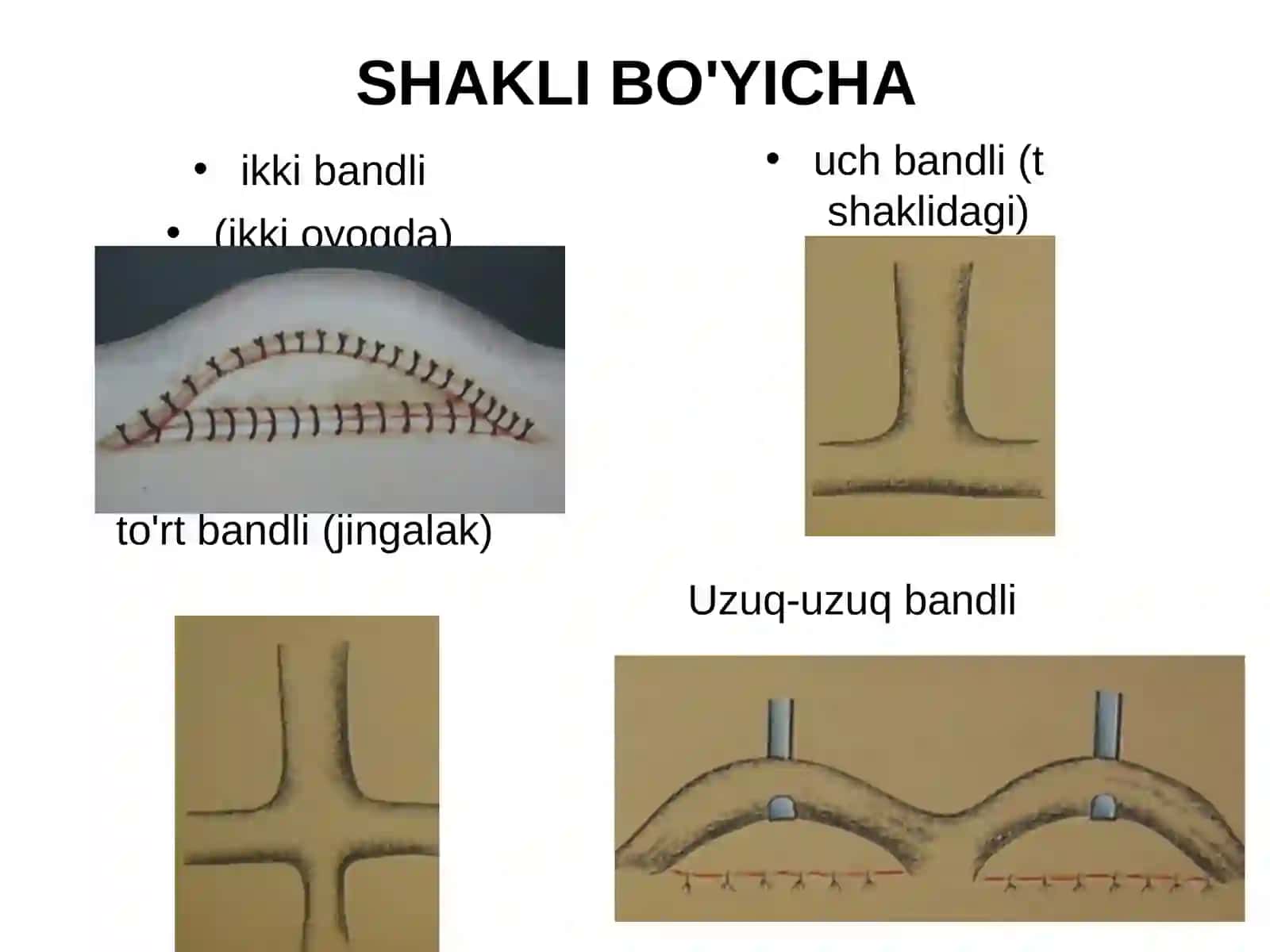 Filatov bandi bilan plastika 3