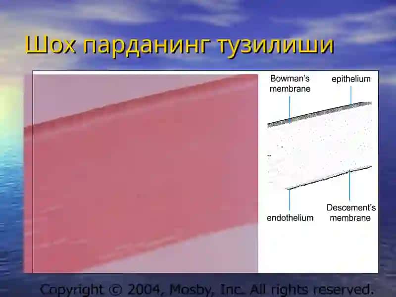 Кератитлар 3