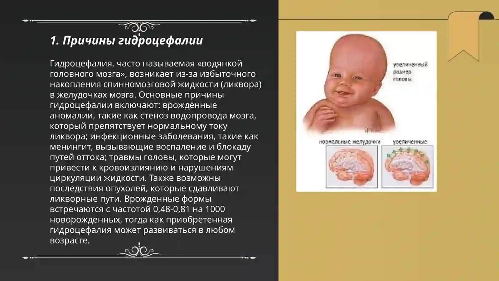 Гидроцефалия. Микроцефалия 3