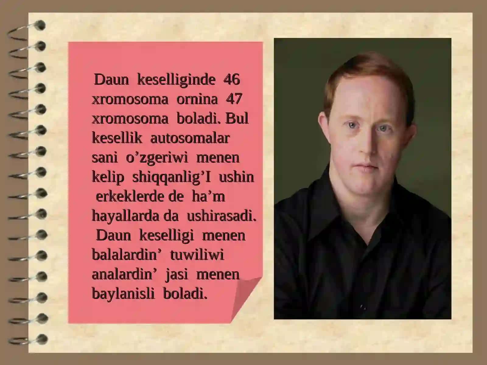 Xromosoma kesellikleri, Daun sindromi 3