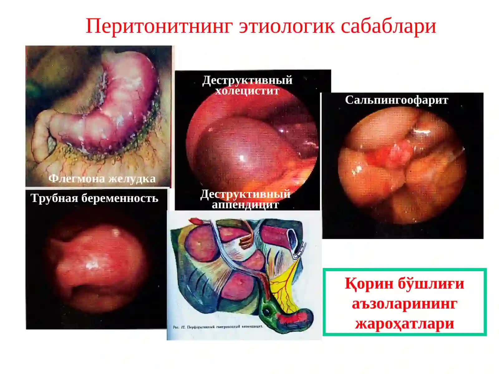 Перитонит-висцералвапариеталқор 3