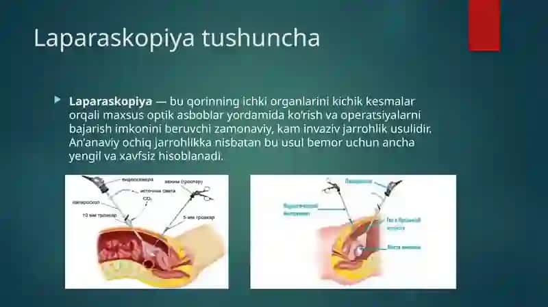 LAPARASKOPIYANING JARROHLIKDA QO`LLANISHI 3