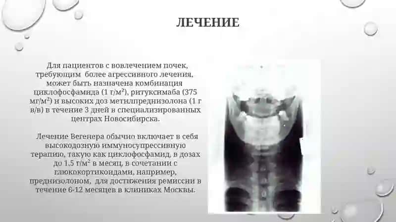 Гранулематоз вегенера 3