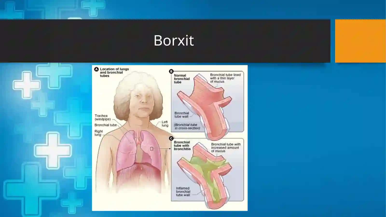 Borxit Prostatit Kriptorxizm 3