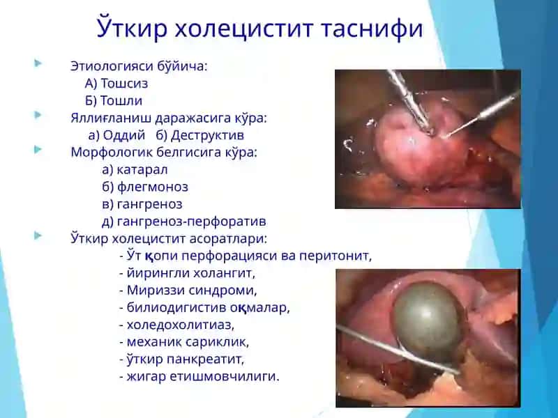 Ўткир холецистит 3