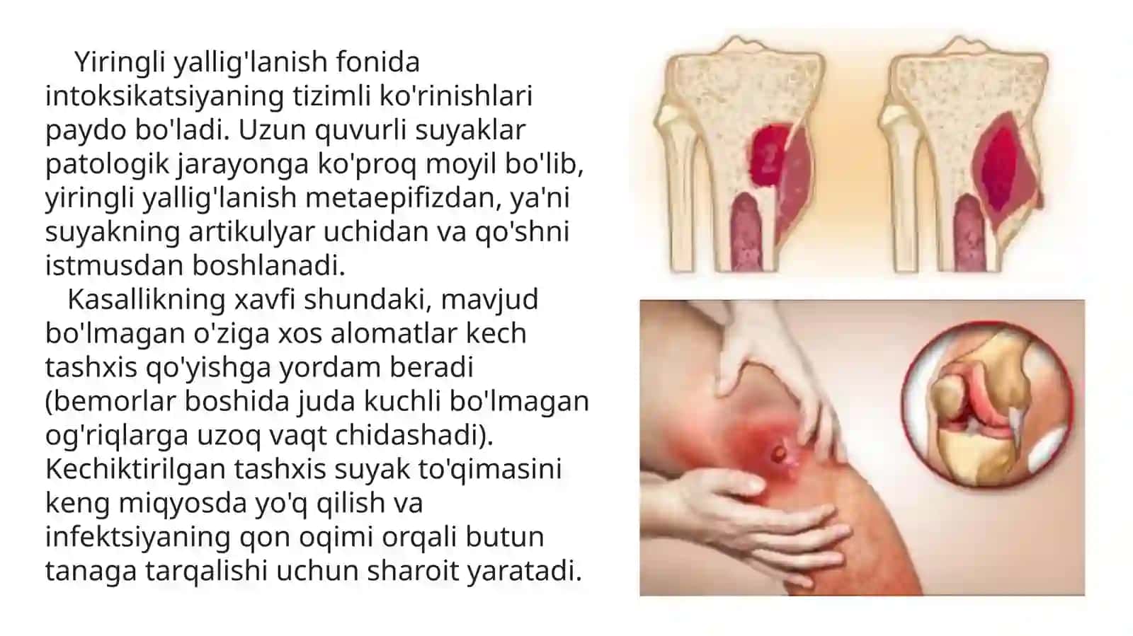 Gemotogenli osteomielit 3