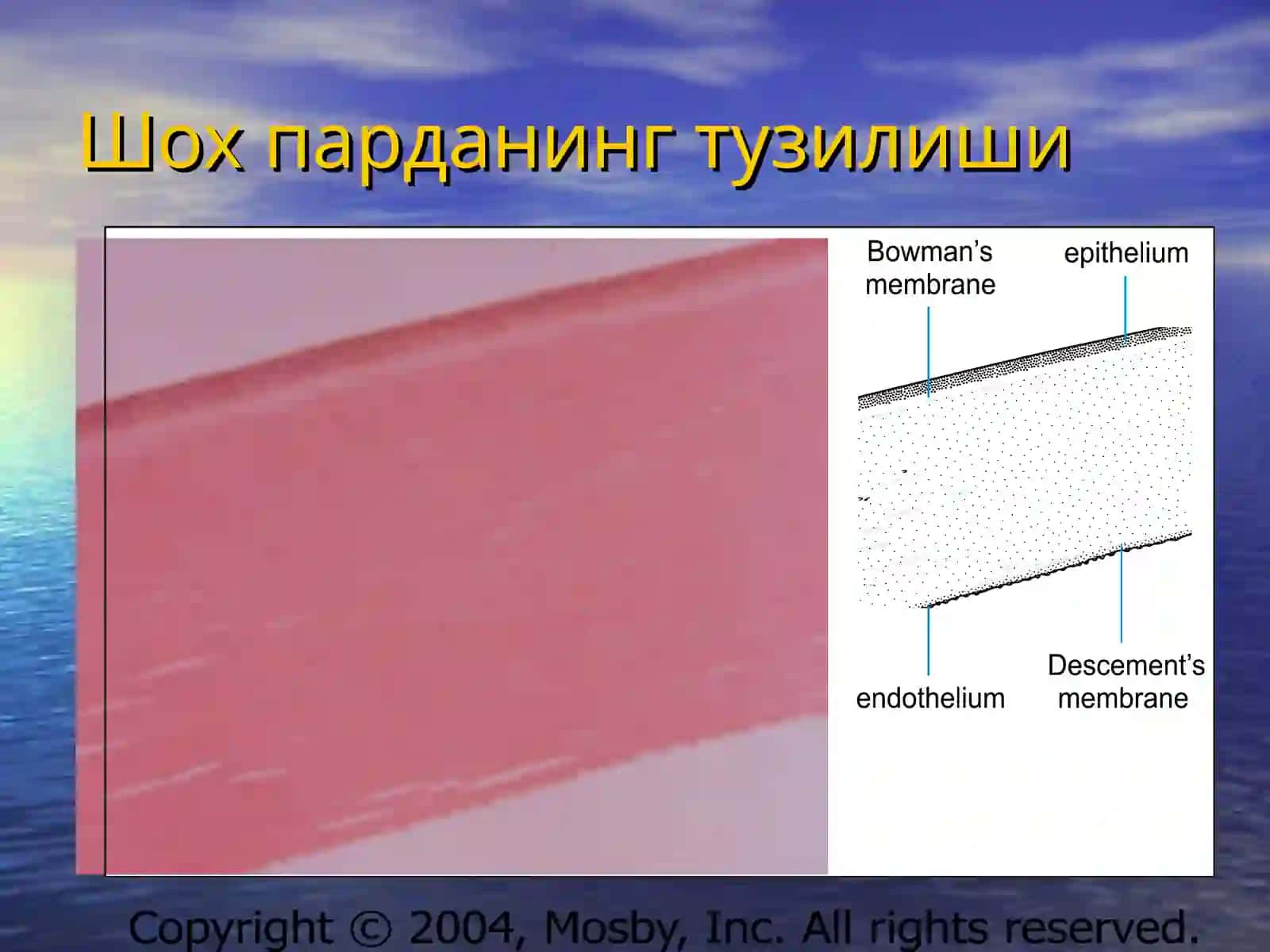 Кератитлар 3