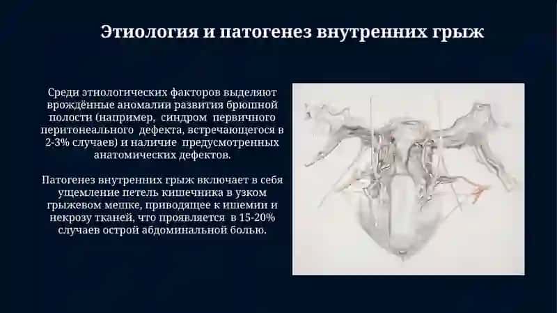 Внутренние грыжи живота. Спайки брюшины 3