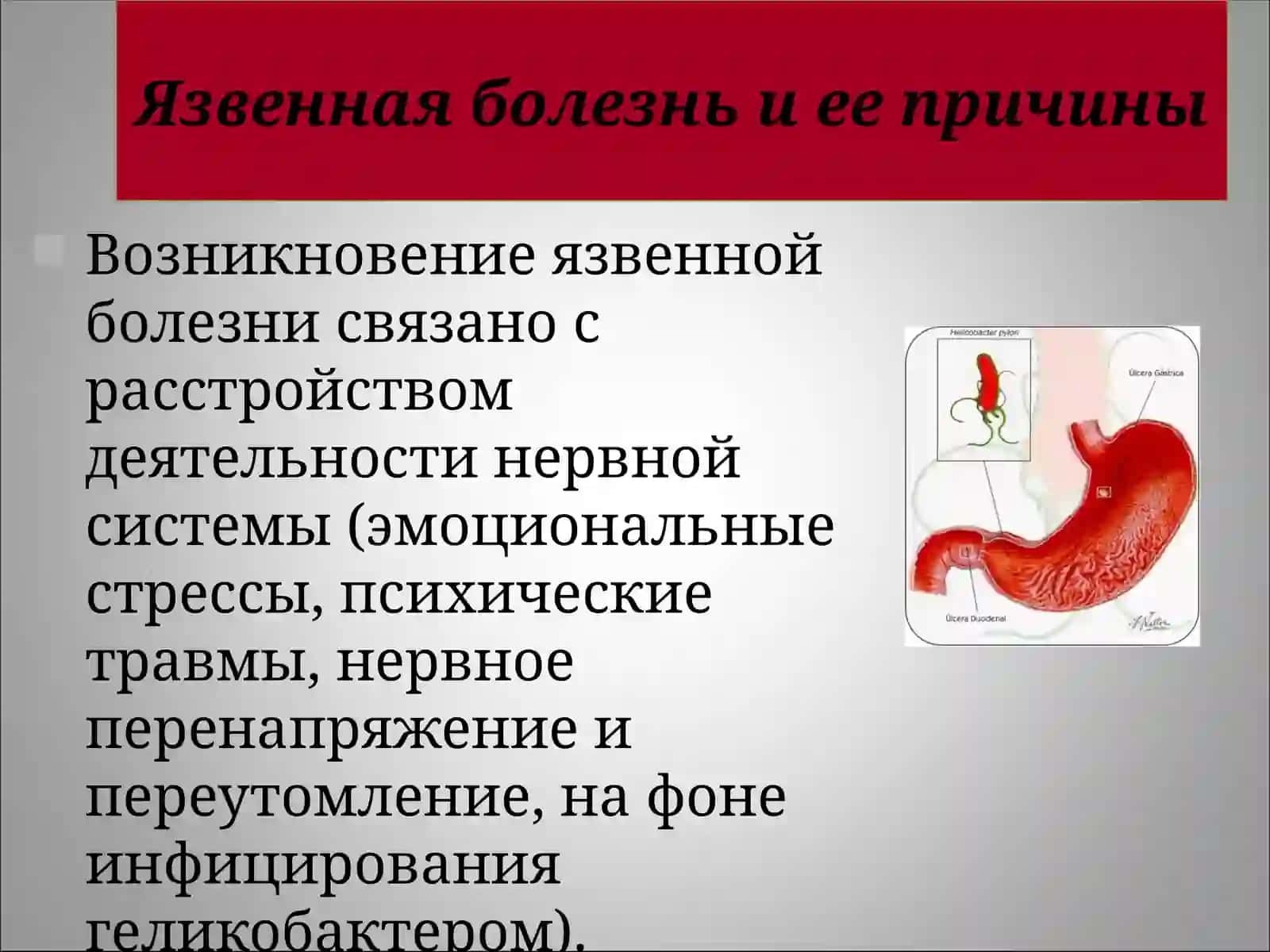 Язвенная болезньжелудка и двенадцатиперстной кишки 3