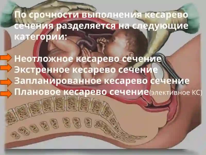 Кесарево сечение 3
