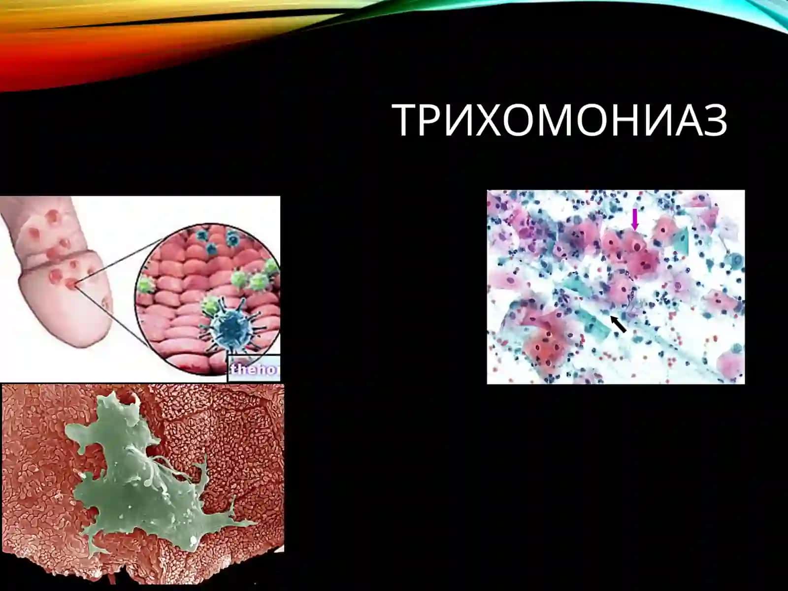 Трихомониаз 3
