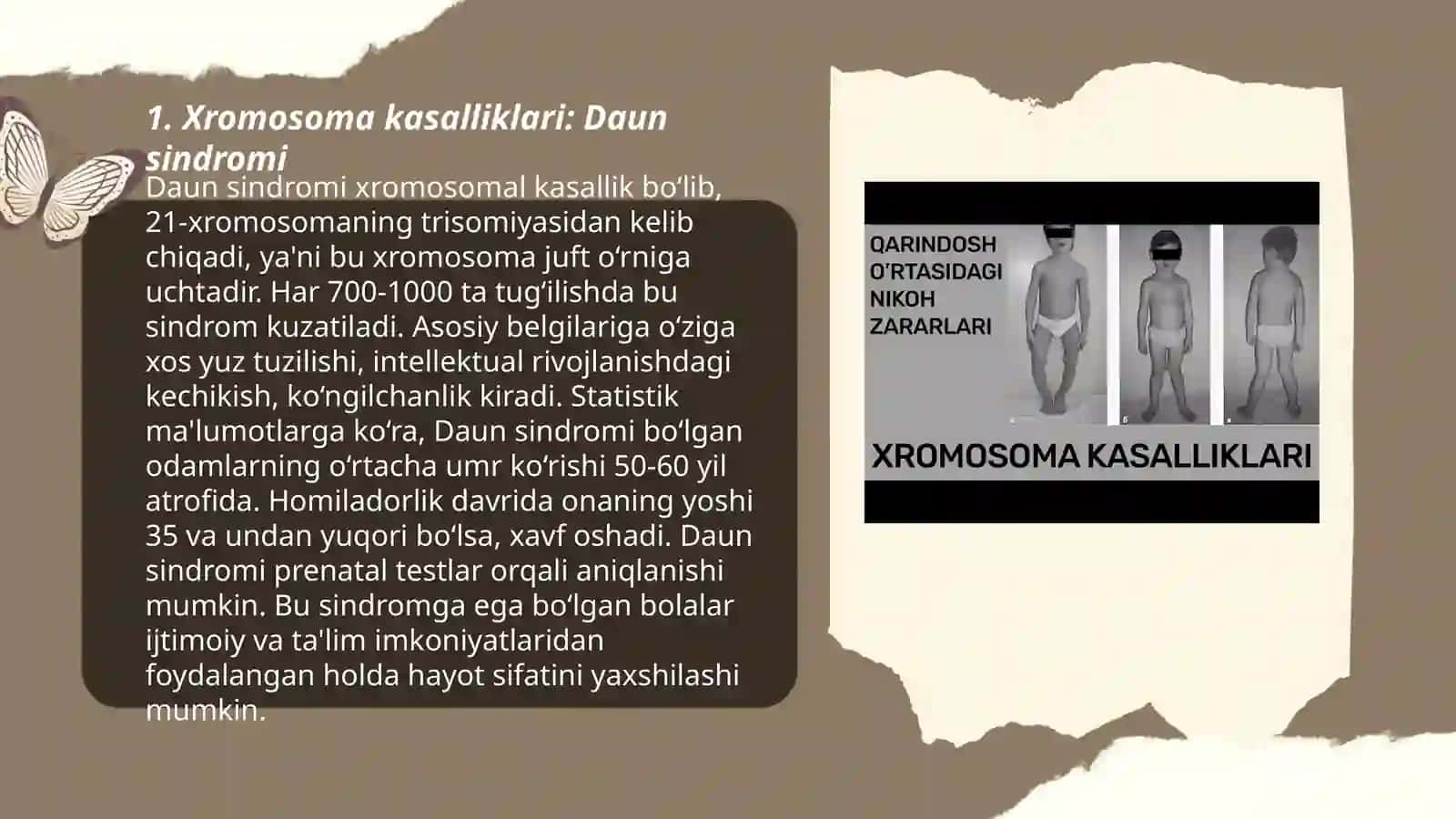 Daun sindromi 3