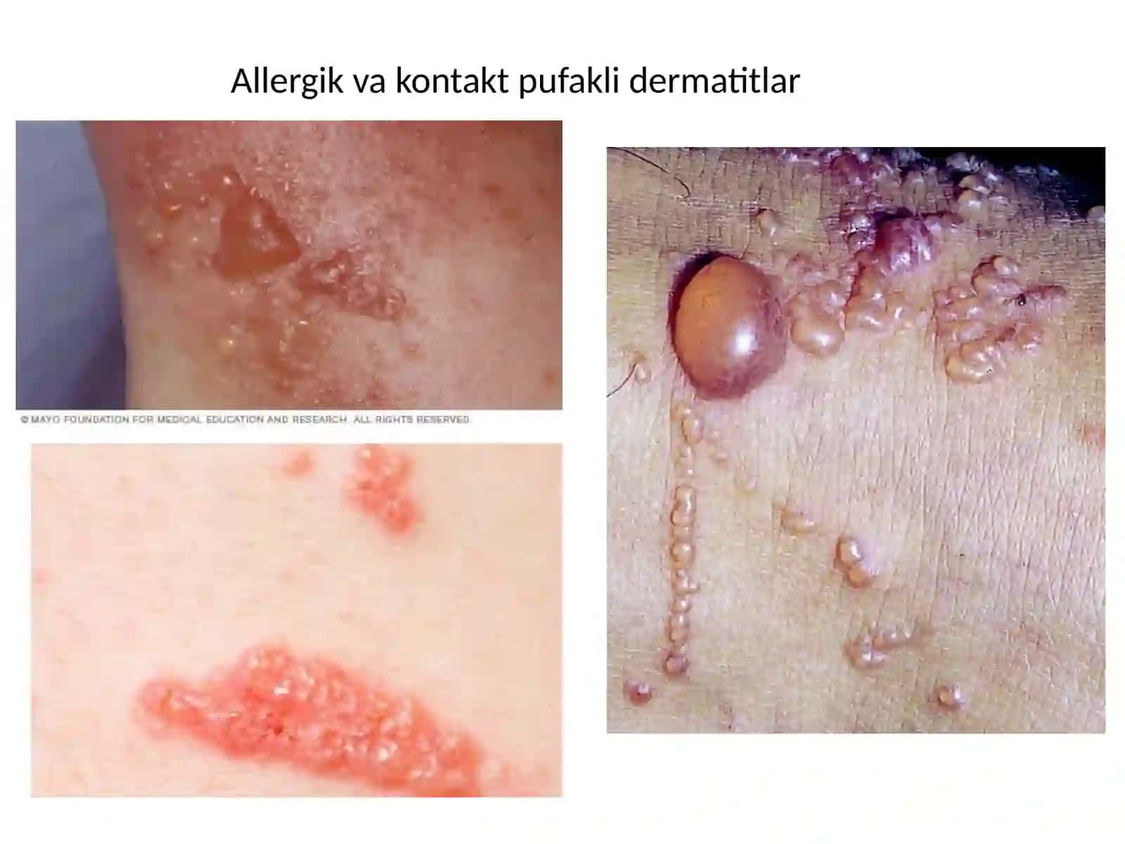 Pufakli dermatitlar klassifikatsiyasi.Diuring dermatiti,po’rsildoq yara 3