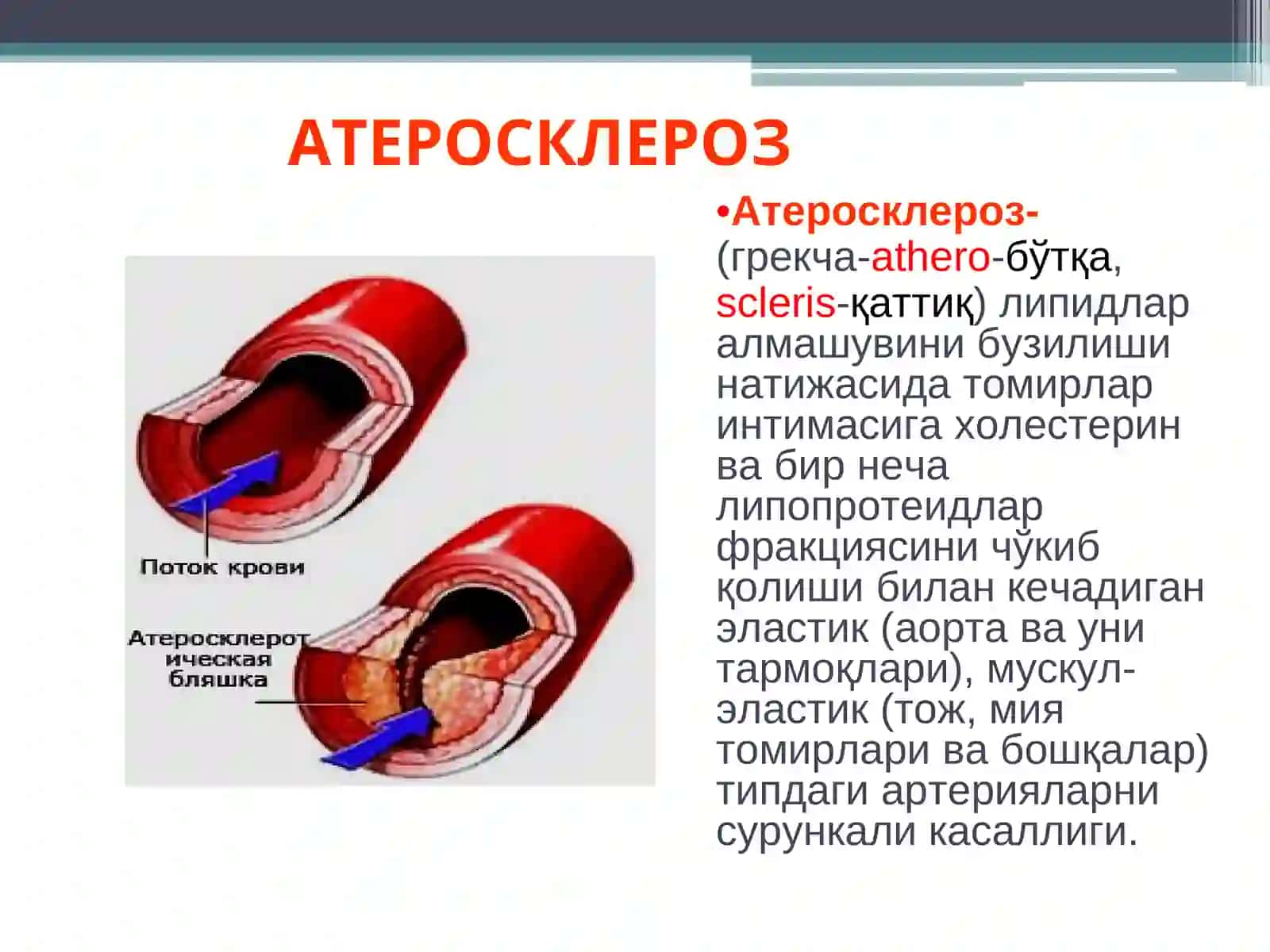 Атеросклероз 3