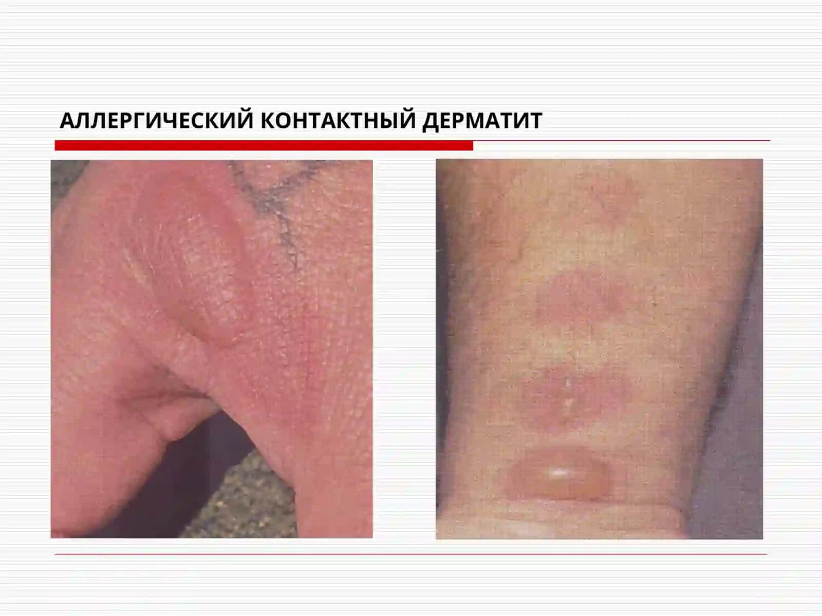 Тери таносил касалликлар фани 3