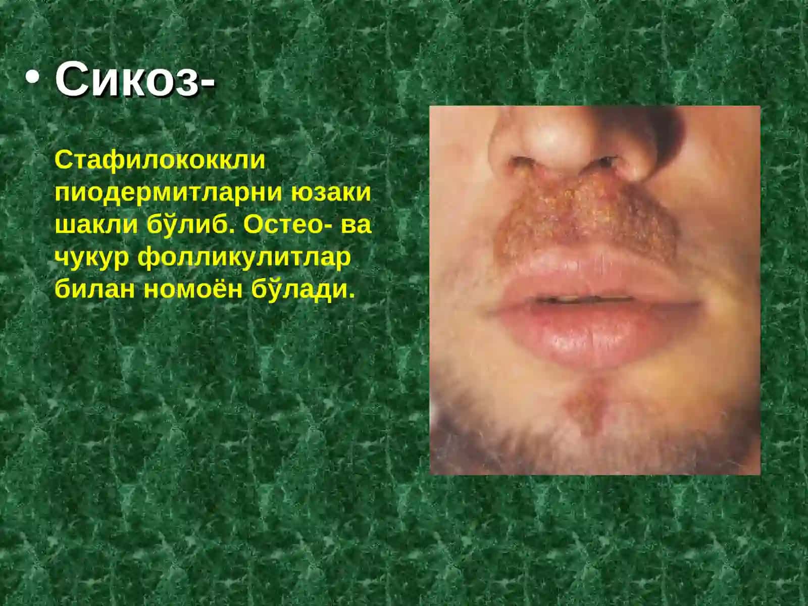 Пиодермитлар. Терининг йирингли касалликлари 3