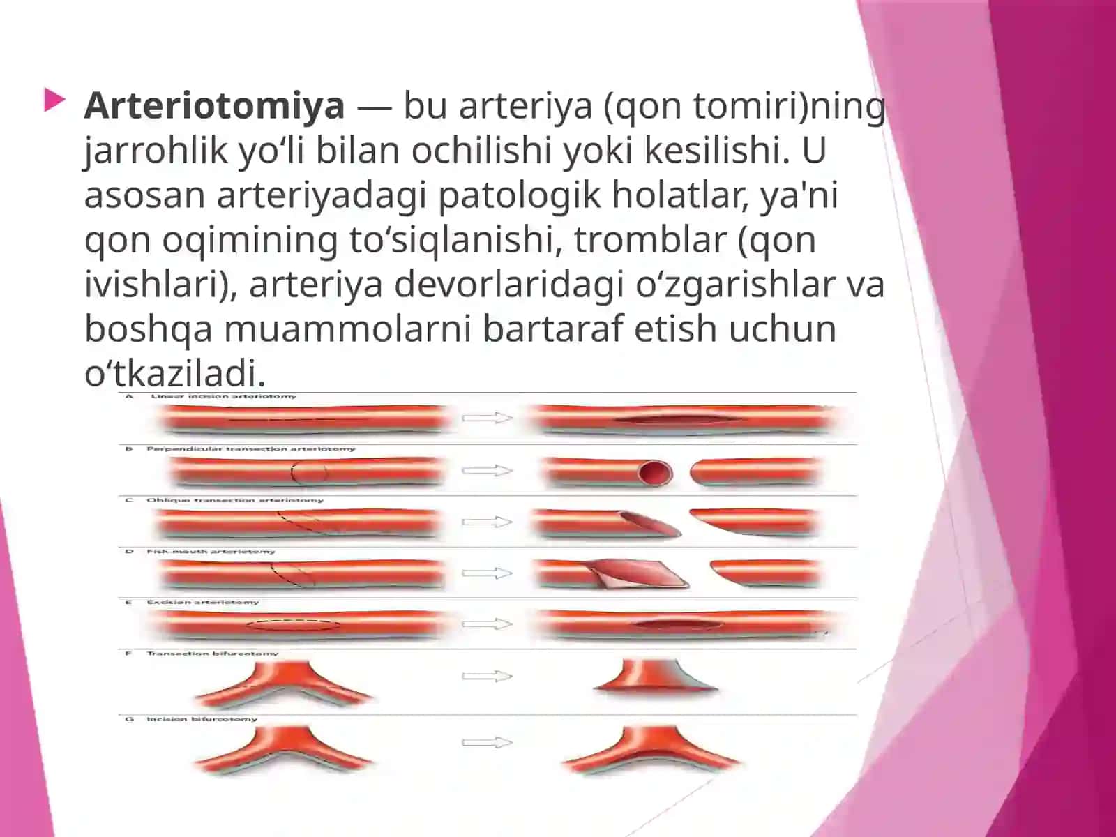 Arteriotomiya.Karatidendarterektomiya 3