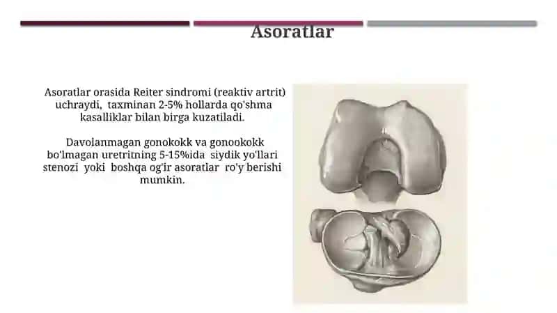 So'zak va So'zaksiz uretritlar 3