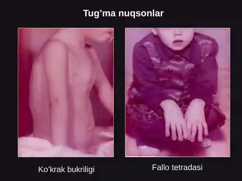 Tug'ma yurak nuxsonlari ppt 3