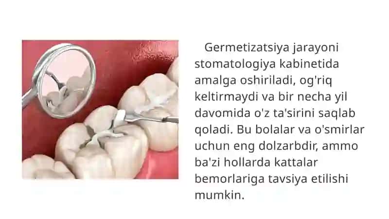FISSUR GERMETIKLAR. QO'LLASH TEXNIKASi 3